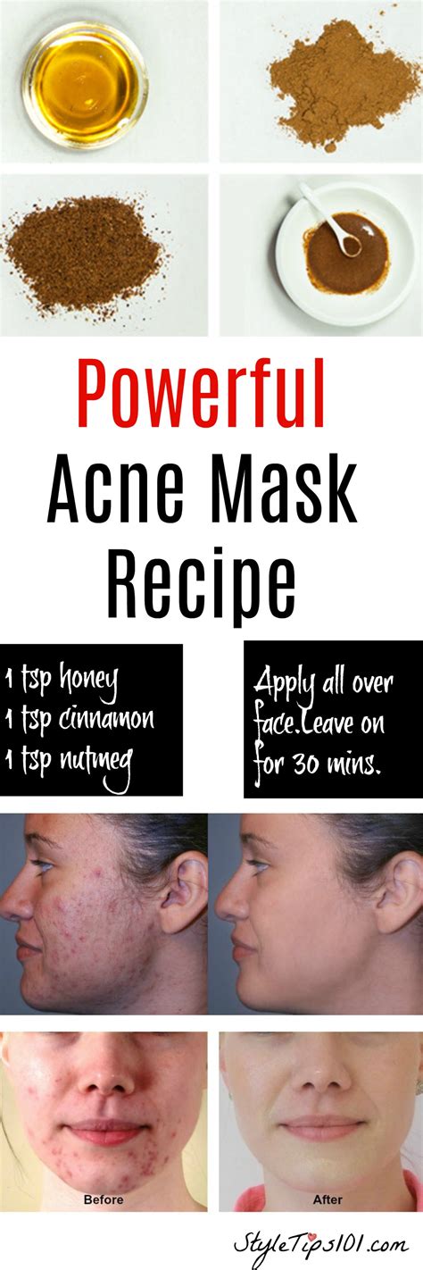 Top estheticians share their favorite homemade face masks for acne. Homemade Natural Acne Mask