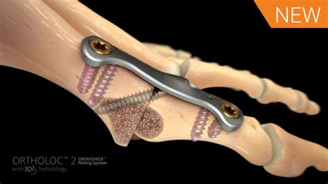 1st Mtp Fusion Animation Featuring Ortholoc™ 2 Crosscheck™ 016676a Vlc