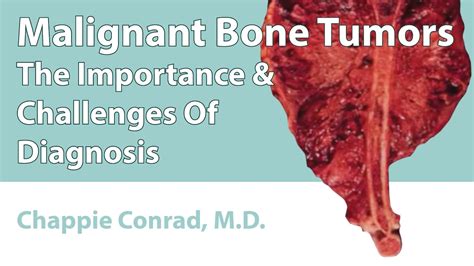 Malignant Bone Tumors The Importance And Challenges Of Diagnosis Youtube