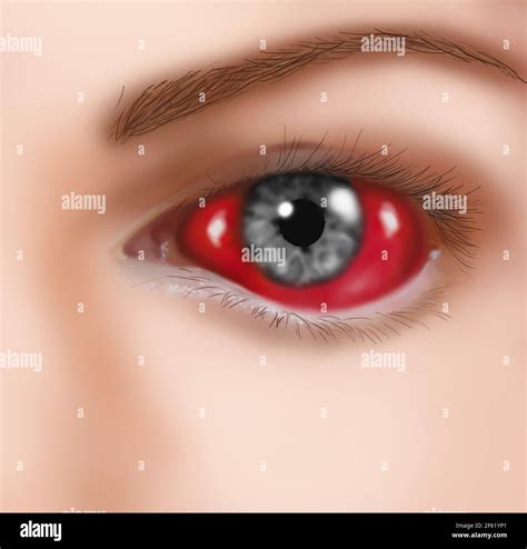 Subconjunctival Hemorrhage Broken Blood Vessel In Eye