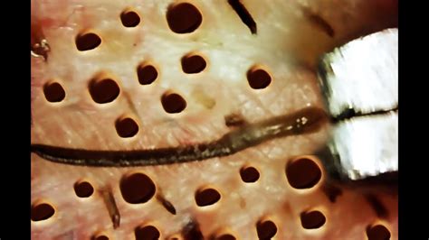 Trypophobia Fear Of Holes Youtube