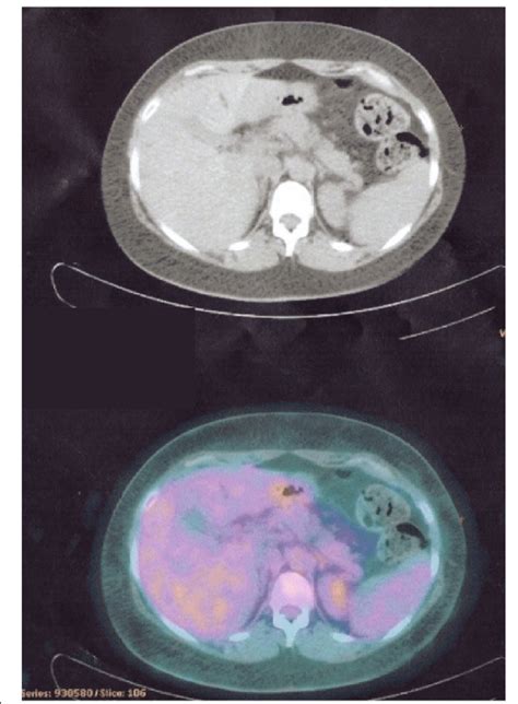 Ctpet Scan Showing Cr In The Liver Lesions Download Scientific Diagram