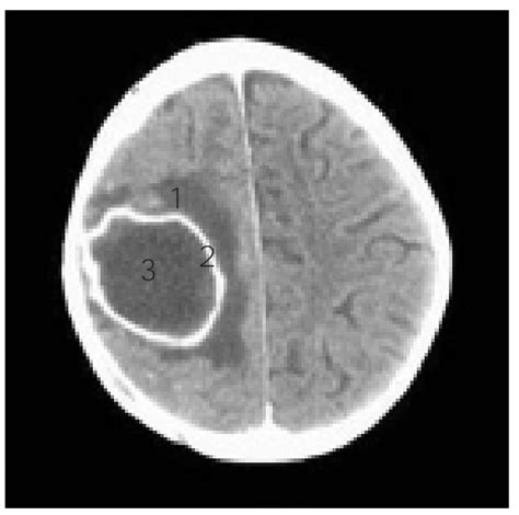 Brain Abscess Concise Medical Knowledge