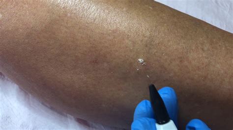 Wart Removal On The Leg Appearances Aesthetics Youtube
