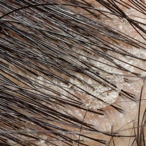 8 Dandruff Myths Vs Realities Dandruff Hair