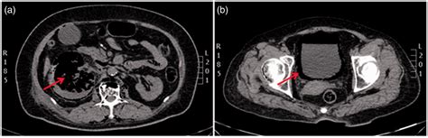 Emphysematous Pyelonephritis And Cystitis A Case Report And Literature