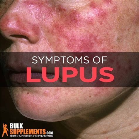 Lupus Causes Symptoms And Treatment