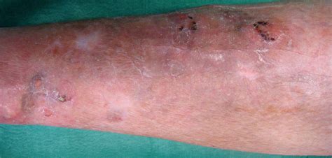 Manchas De Pele As 5 Causas Mais Comuns Artrite Reumatoide Zohal