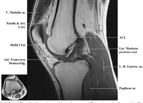 Knee Muscle Anatomy Mri Mri Knee Anatomy Knee Sagittal Anatomy