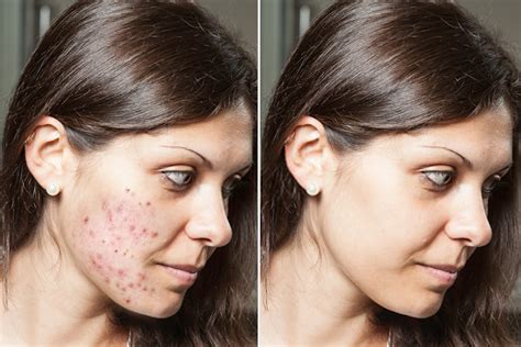 How To Remove Acne Scars And Pimples Marks With Cucumber Get Clean