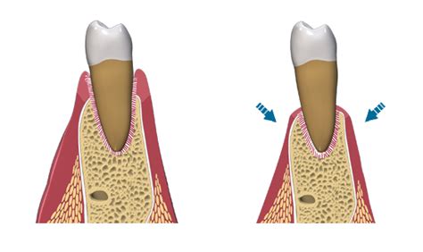 Bone loss seen on radiographs is an indicator of past disease activity. Bone Loss Due to Gum Disease