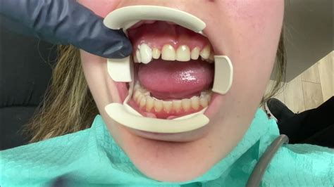 Houston Cosmetic Dentist Step By Step Placement Of Minimal Prep