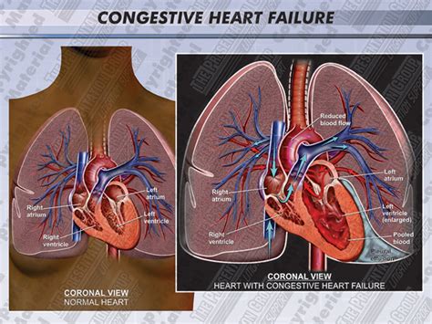 Congestive Heart Failure Medical Legal Illustration