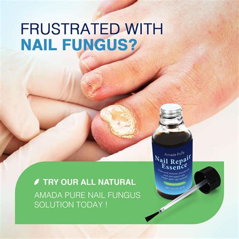 Toenail Fungus Treatment Nail Fungus Treatment Fungus Stop Fingernail Fungus Fungi Nail