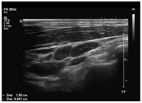 Lymphoma Cancerous Lymph Nodes In Neck Ultrasound Pdf Ultrasound Of