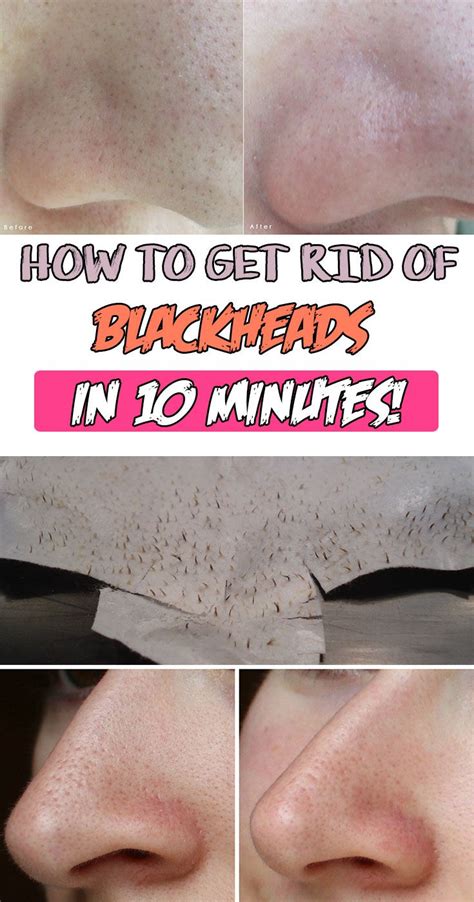 How To Get Rid Of Blackheads In 10 Minutes Get Rid Of Blackheads