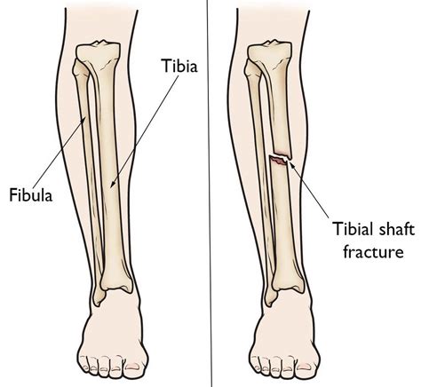 Pdf Ankle Fracture Associated With Tibia Shaft Fractures My Xxx Hot Girl