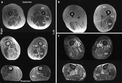 Inclusion Body Myositis Mri