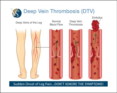 Dvt Deep Vein Thrombosis Is Usually A Condition That Starts In The