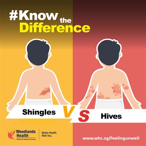 Didyouknow That Shingles Is Caused By Woodlands Health Facebook