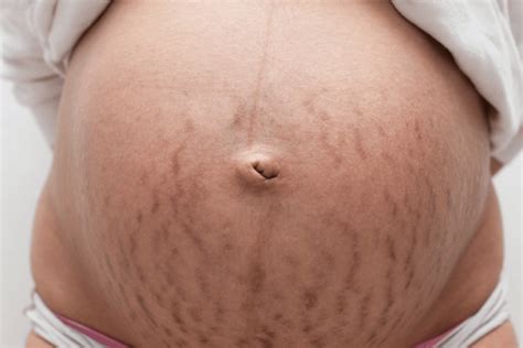 9 Simple Steps To Prevent And Improve Pregnancy Stretch Marks 9 Simple