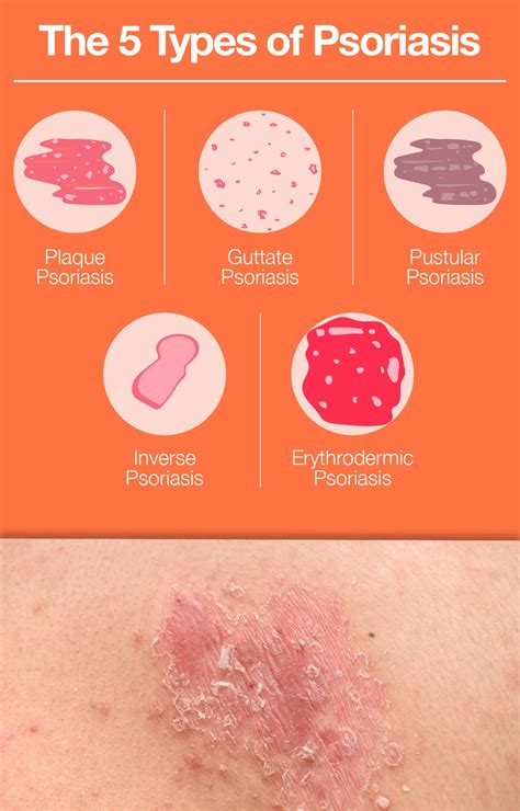 What Is Psoriasis Learn About Causes Symptoms Treatments The Amino Company