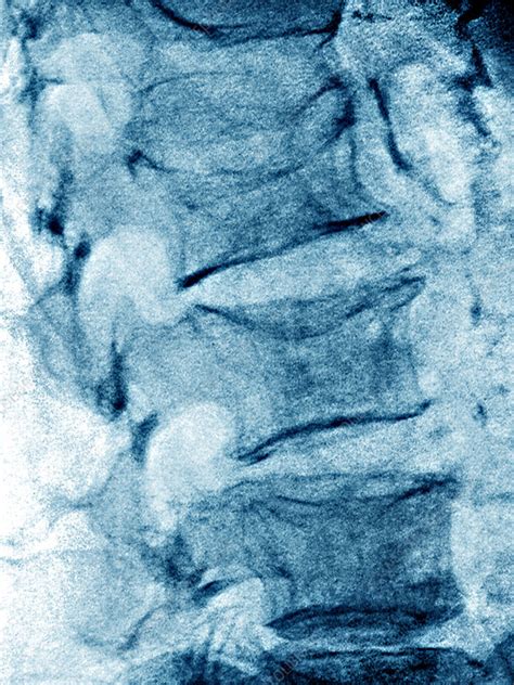 Osteoporosis X Ray Stock Image C0272191 Science Photo Library