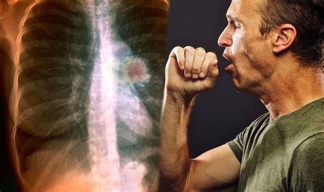Lung Cancer Symptoms Five Signs In Your Cough Of The Deadly Disease
