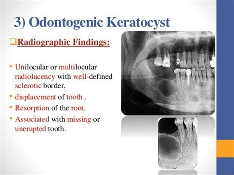 Odontogenic Keratocyst Radiology Imaging Surgical Nursing