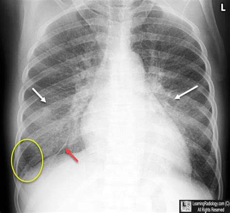 Learning Radiology Congestive Heart Failure Pulmonary Edema