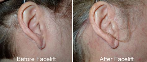 Facelift Incisions And Scars Richmond Va Hidden Facelift Scars