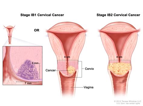 Figure Stage IB And IB Cervical PDQ Cancer Information Summaries NCBI Bookshelf