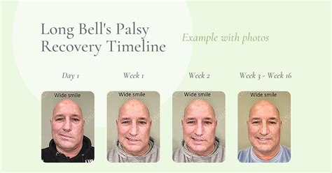 Bells Palsy Ideas Bells Palsy Facial Nerve Bell S Palsy Recovery My