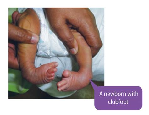 Foot) (n.) … etymology dictionary. Treating Clubfoot - Positive Parenting