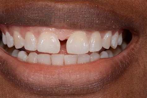 3 to 4 appointments,and the total time required will be. Fixing Gaps Between Front Teeth