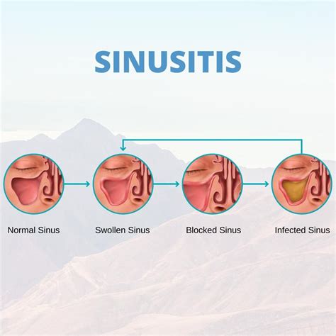 👃 Sinusitis Is An Inflammation Of The Tissues Lining The Sinuses When
