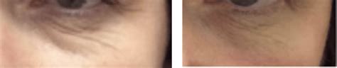 Under Eye Wrinkle Treatments At Cheshire Lasers Middlewich