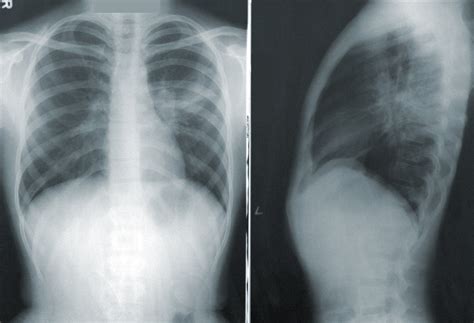 A Neural Network Can Help Spot Covid 19 In Chest X Rays Mit