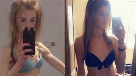 Anorexic Says Chocolate Helped Her Survive Extreme Eating Disorder