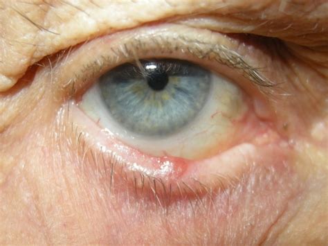 Basal Cell Carcinoma On Eyelid