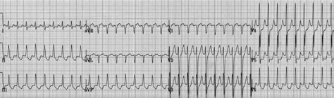 Some patients are unaware that their heart is beating quickly. Psvt / Float Nurse: EKG Rhythm Strip Quiz 3 : Psvt ...