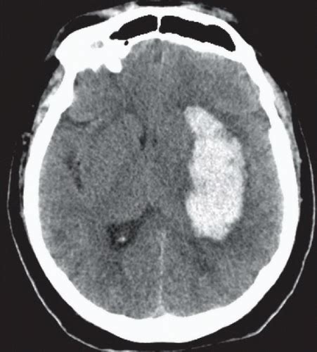 Hypertensive Basal Ganglia Hemorrhage Radiology Key