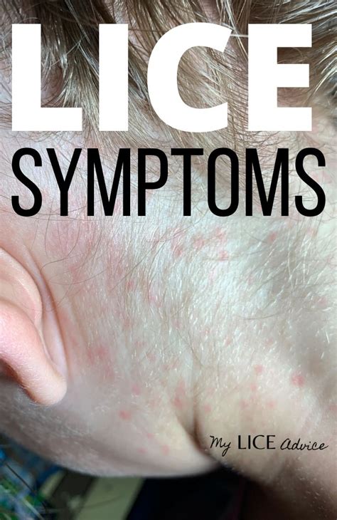 17 Lice Symptoms With Pictures Signs That You Have Head Lice In 2020