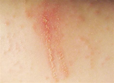 6 Types Of Eczema Symptoms And Causes 2022