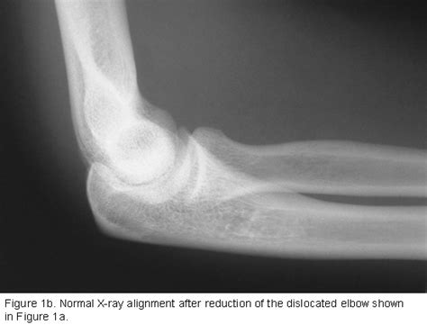 Dislocated Elbow Orthopedic Specialists Of Seattle