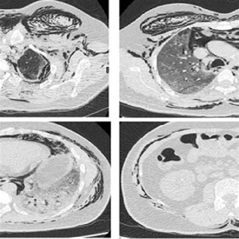 Ct Chest And Abdomen Showing Extensive Se And Pneumoperitoneum