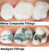 Remove Silver Fillings Pictures