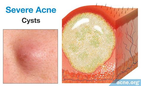 What Is Acne An In Depth Look Acne Org