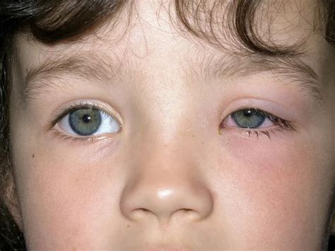 Pink Eye Symptoms Discover How To Recognize Them Properly And Get