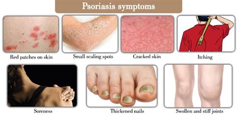 Causas De La Psoriasis
